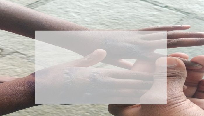 ಊಟ ಕೇಳಿದ್ದೆ ತಪ್ಪಾಯ್ತಾ? ಪುಟ್ಟ ಕಂದಮ್ಮನ ಕೈ ಸುಟ್ಟ ಪಾಪಿ ಮಲತಾಯಿ kalburgi