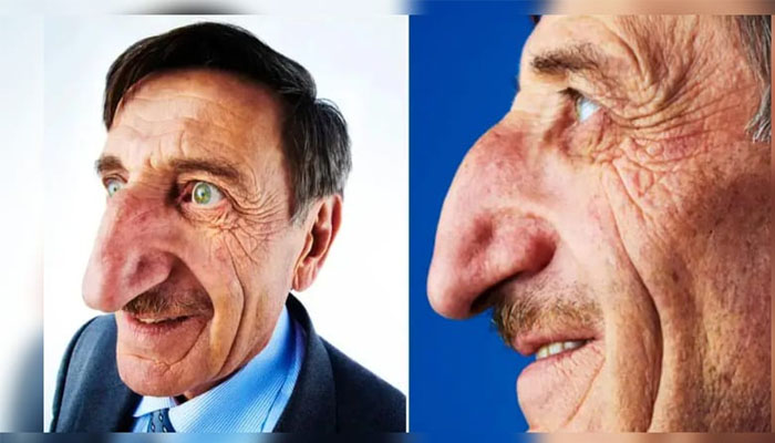 ಜಗತ್ತಿನ ಅತಿ ದೊಡ್ಡ ಮೂಗಿನ ವ್ಯಕ್ತಿ ವಿದಾಯ nose