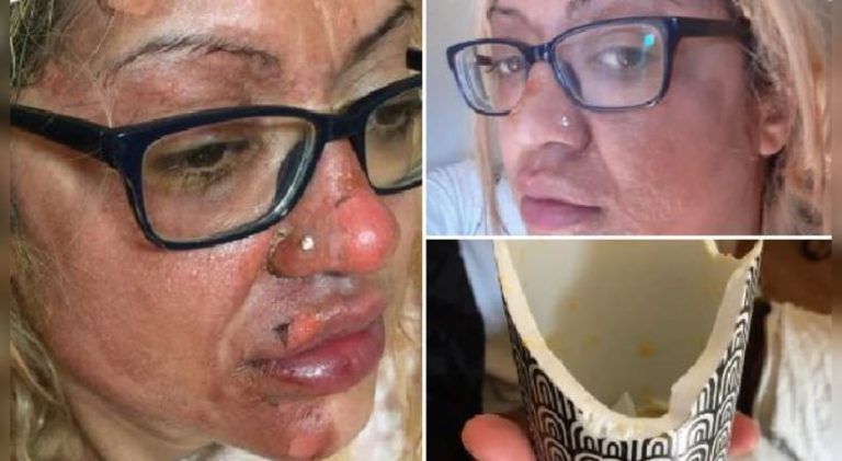 ಅಡುಗೆ ಪ್ರಯೋಗ; ಮೊಟ್ಟೆ ಸ್ಫೋಟಗೊಂಡು ಯುವತಿಗೆ ಸುಟ್ಟ ಗಾಯ blast