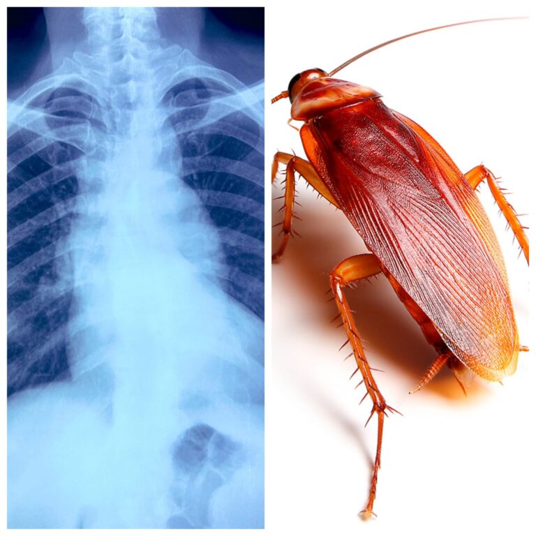 ವ್ಯಕ್ತಿಯ ಶ್ವಾಸಕೋಶದಲ್ಲಿ ಜಿರಳೆ ಪತ್ತೆ..! cocroach