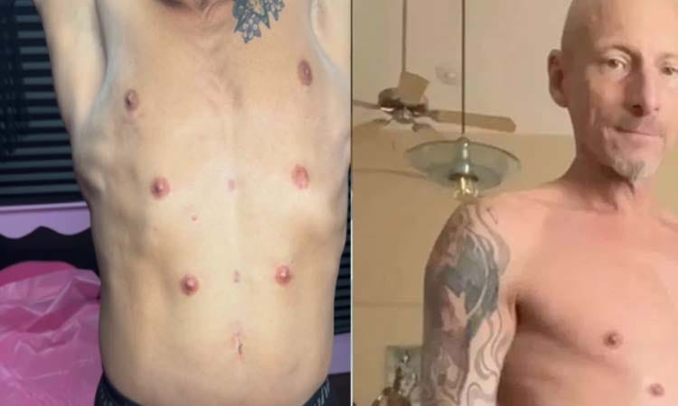 ಆರು ಮೊಲೆತೊಟ್ಟು ಹೊಂದಿರುವ ವ್ಯಕ್ತಿ ಇವರು: ಇದರ ಹಿಂದಿನ ಸತ್ಯ ತಿಳಿದ್ರೆ ಶಾಕ್ ಆಗ್ತಿರಿ..! america